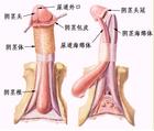尿道下裂临床表现